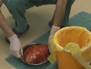 八斤肿瘤“连累”左肾被切除