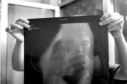 <em>女孩6岁</em>才被验出是男儿身 男女<em>生殖器</em>均无_性