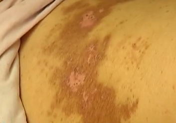 寻医问药：蛇缠腰留下的后遗症
