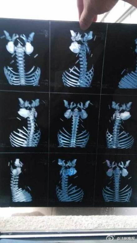 新闻17点:被扎钢针女婴舅妈自杀 吊瓶妈妈成