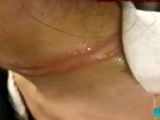推拿院里拔火罐 酒精烧伤后背