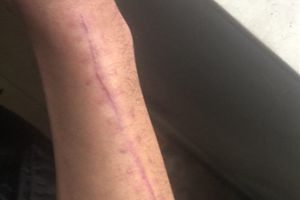 拳击私教课上骨折花了三万多，索赔俩月无果相关员工均已离职