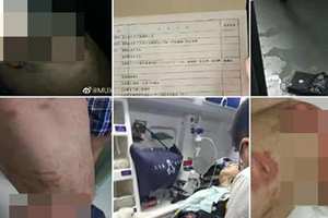 小米手机爆燃烫伤人?当事人称小米员工已上门解决