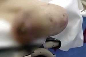 6旬老人疑被家人遗弃 截肢后屡次破坏伤口拒出院 