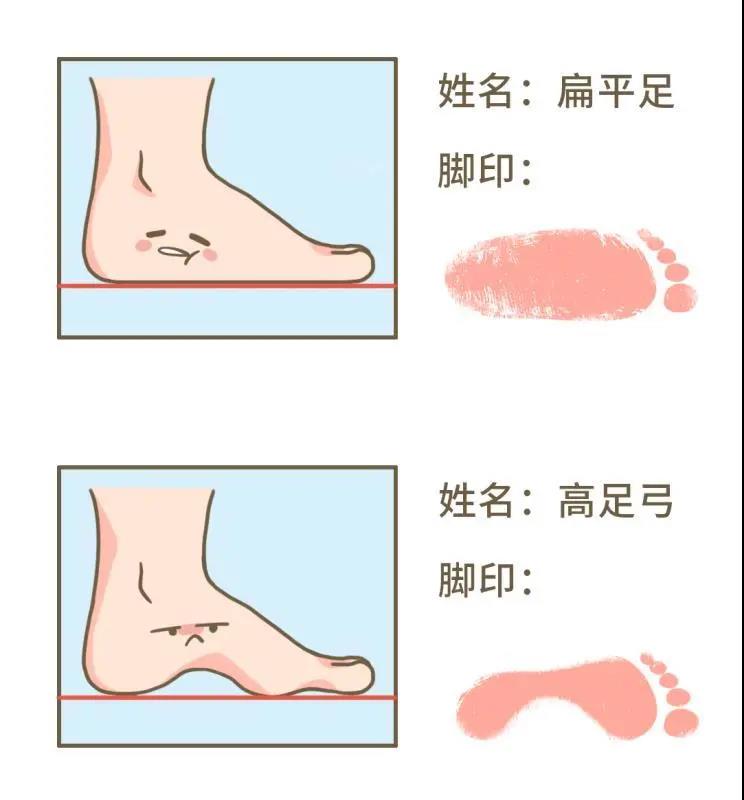 扁平足|总嚷嚷走不动的人，可能是脚没长对！