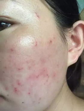 最后还有一点需要注意的是,如果身上发现网状血丝,也叫蜘蛛痣,那么
