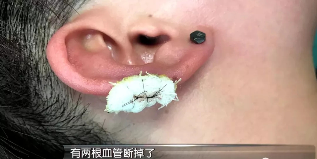 汤医生介绍, 小张耳朵里的两个血管被剪了,血往外喷出,他赶紧加压